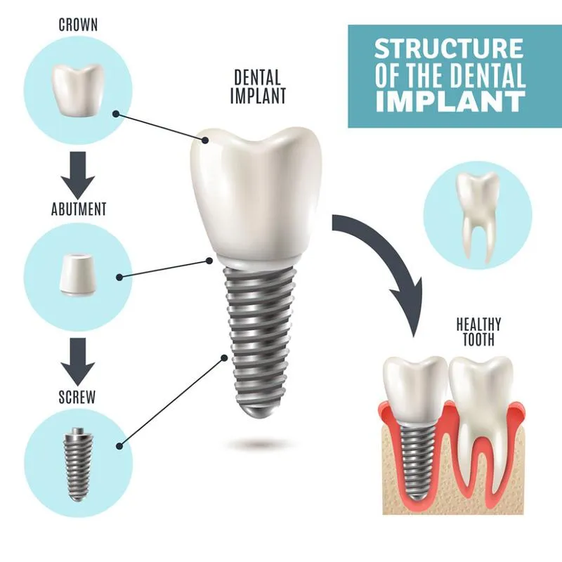 Tác hại của việc trồng răng implant có thể bạn chưa biết