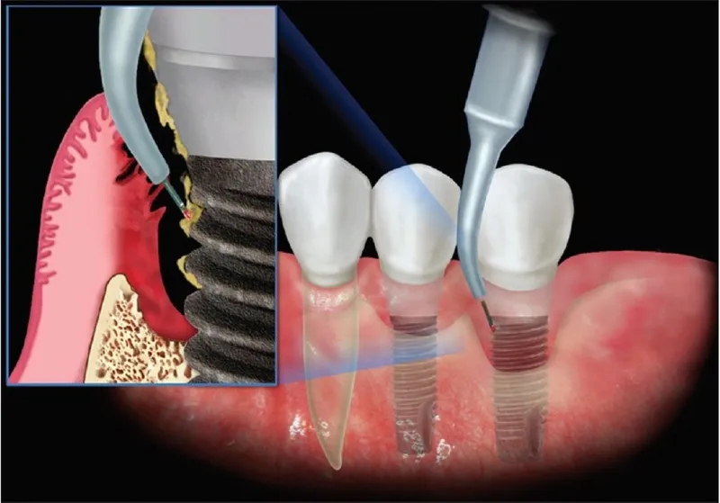 Tác hại của việc trồng răng implant có thể bạn chưa biết