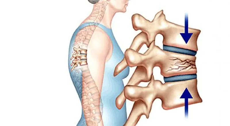 Tăng phospho máu là gì? Cách điều trị và phòng ngừa