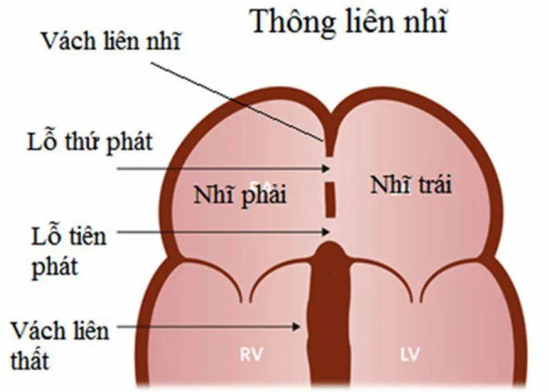 Thông liên nhĩ lỗ thứ phát có nguy hiểm không?