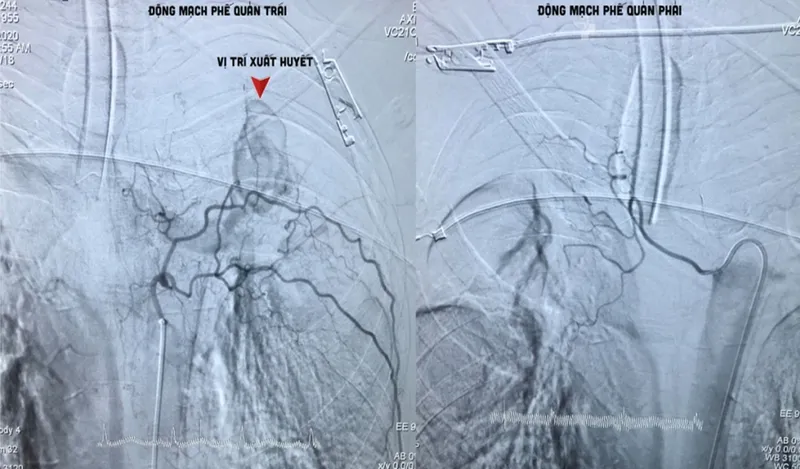 Tìm hiểu phương pháp nút động mạch phế quản điều trị ho ra máu