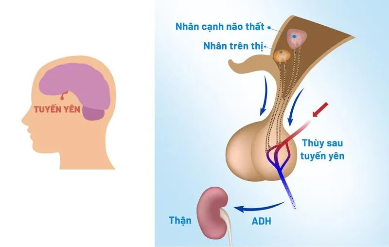 Tìm hiểu về hội chứng tiết ADH không thích hợp