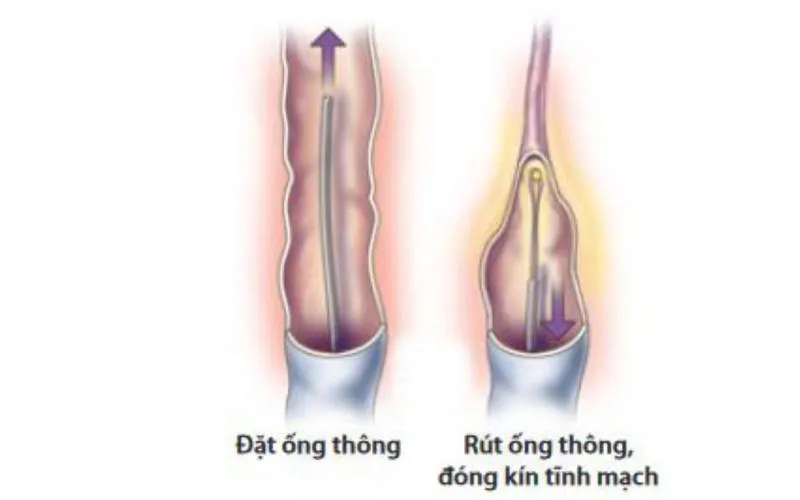 Tĩnh mạch đùi: Vị trí, chức năng và ý nghĩa lâm sàng trong y học