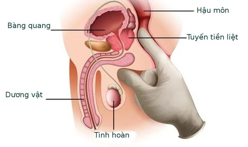 Tinh trùng trào ngược sau 30 phút nằm ngửa là tình trạng gì?