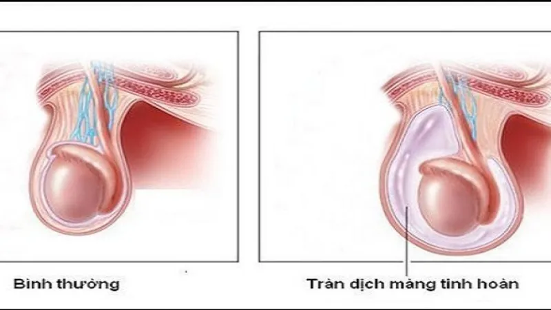 Tràn dịch màng tinh hoàn ở trẻ sơ sinh có nguy hiểm không?