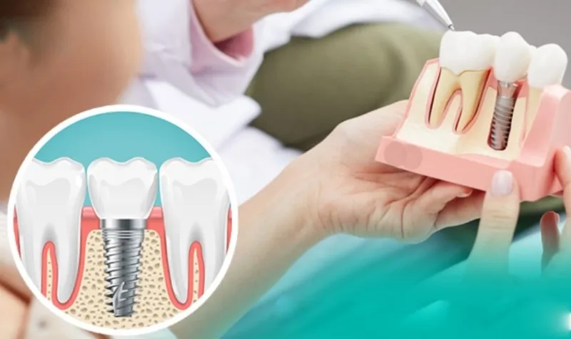 Trồng răng Implant toàn hàm - Giải pháp hiệu quả cho người mất răng