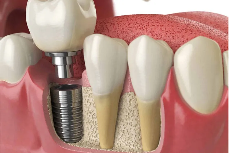 Trồng răng Implant toàn hàm - Giải pháp hiệu quả cho người mất răng