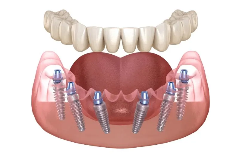 Trồng răng Implant toàn hàm - Giải pháp hiệu quả cho người mất răng