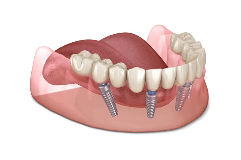 Trồng răng Implant toàn hàm - Giải pháp hiệu quả cho người mất răng