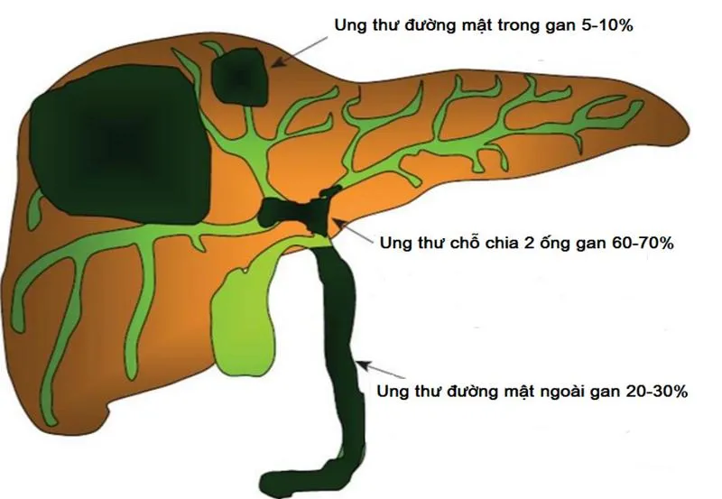 Ung thư đường mật sống được bao lâu?