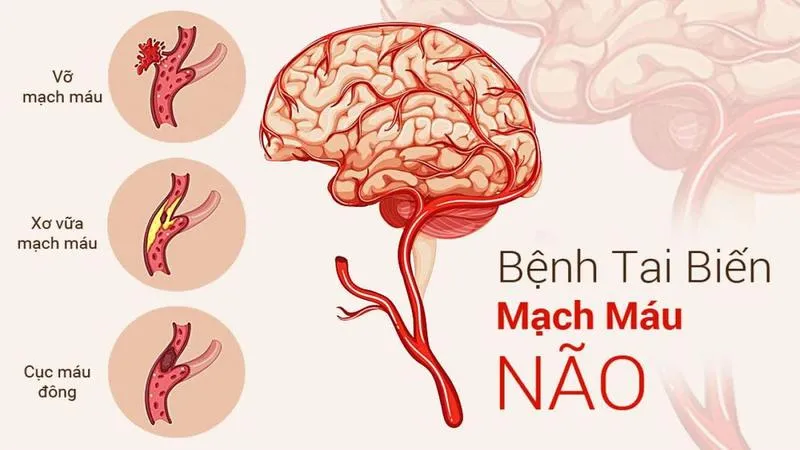 Viên uống Kinh Vương Não Bộ có tốt không? Ai nên sử dụng Kinh Vương Não Bộ?