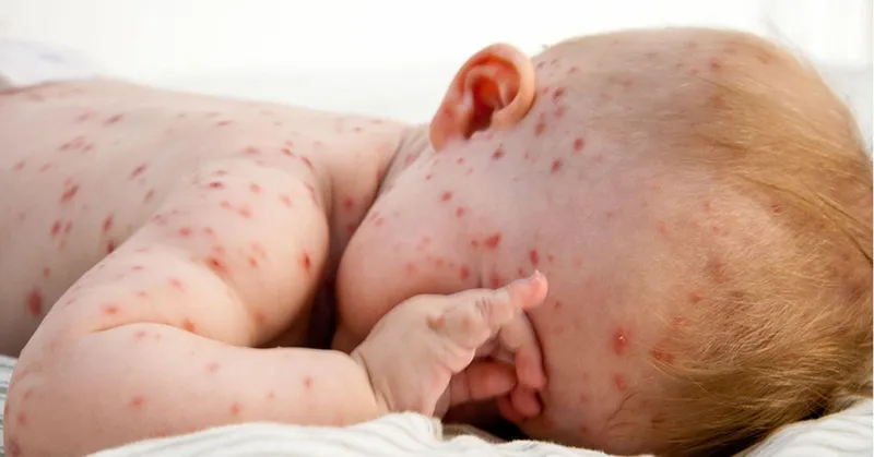 Virus thủy đậu sống trong bao lâu? Cách chữa trị và phòng ngừa