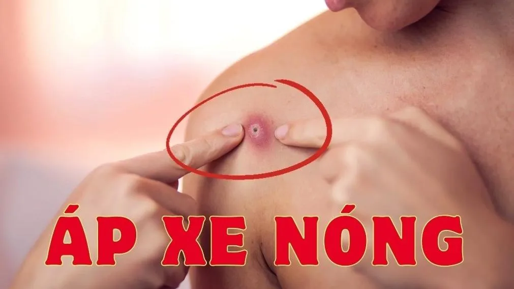 Áp xe nóng là gì? Có gì khác với áp xe lạnh?