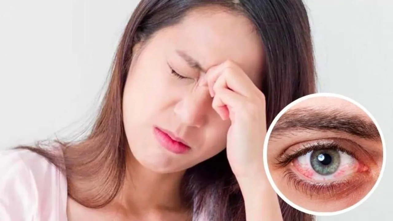 Bị đau mắt đỏ có sốt không? Một số lưu ý khi điều trị bệnh đau mắt đỏ