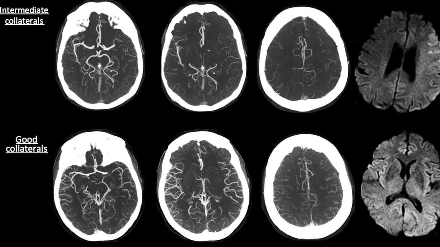 Các đặc điểm trên hình ảnh CT nhồi máu não không phải ai cũng biết