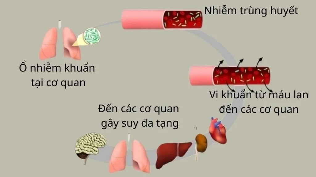 Các phương pháp chẩn đoán sốc nhiễm khuẩn và cách điều trị bệnh