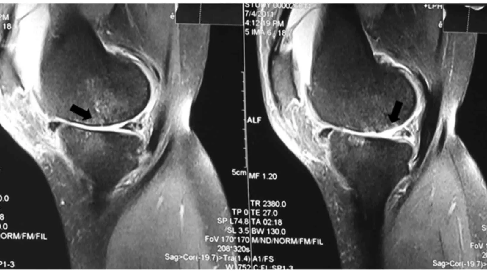 Chụp MRI khớp gối: Chỉ định và quy trình thực hiện