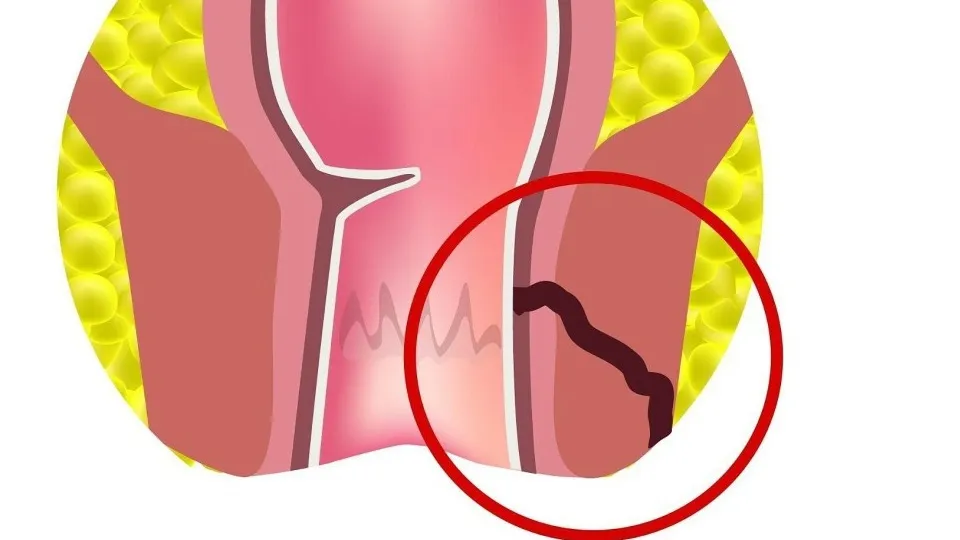 Chụp MRI rò hậu môn: Cơ chế, đối tượng chỉ định và chống chỉ định chụp cộng hưởng từ