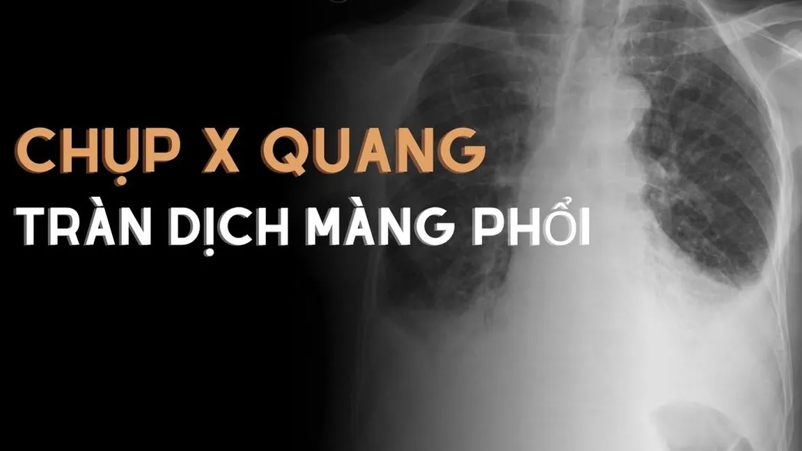 Chụp X quang tràn dịch màng phổi có ý nghĩa gì? Có rủi ro không?