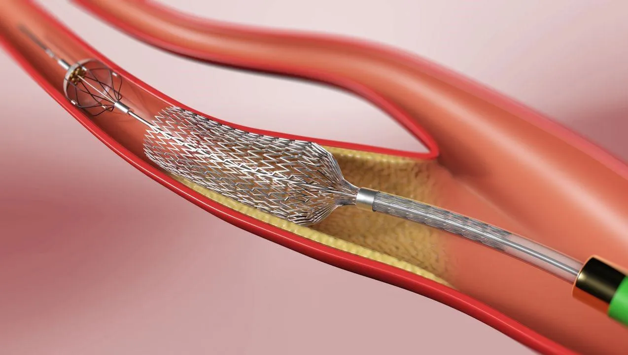 Đặt stent động mạch cảnh là gì? Khi nào cần đặt stent động mạch cảnh?