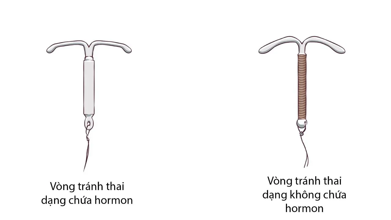 Đặt vòng tránh thai có tăng cân không, có nên tháo khi tăng cân?