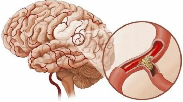 Đau đầu mạch máu: Nguyên nhân và cách điều trị bệnh ra sao?