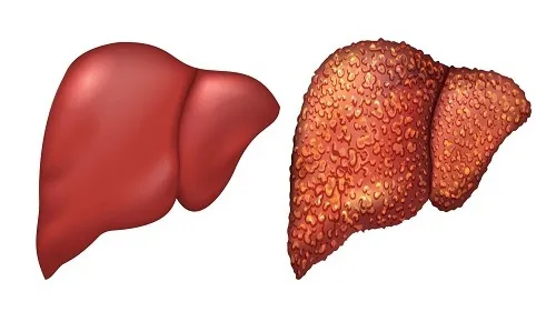 Gan nhiễm mỡ độ 2 là gì? Bị gan nhiễm mỡ độ 2 uống thuốc gì?