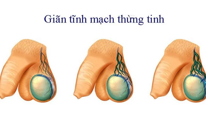 Giãn tĩnh mạch thừng tinh 4mm có nguy cơ vô sinh không?