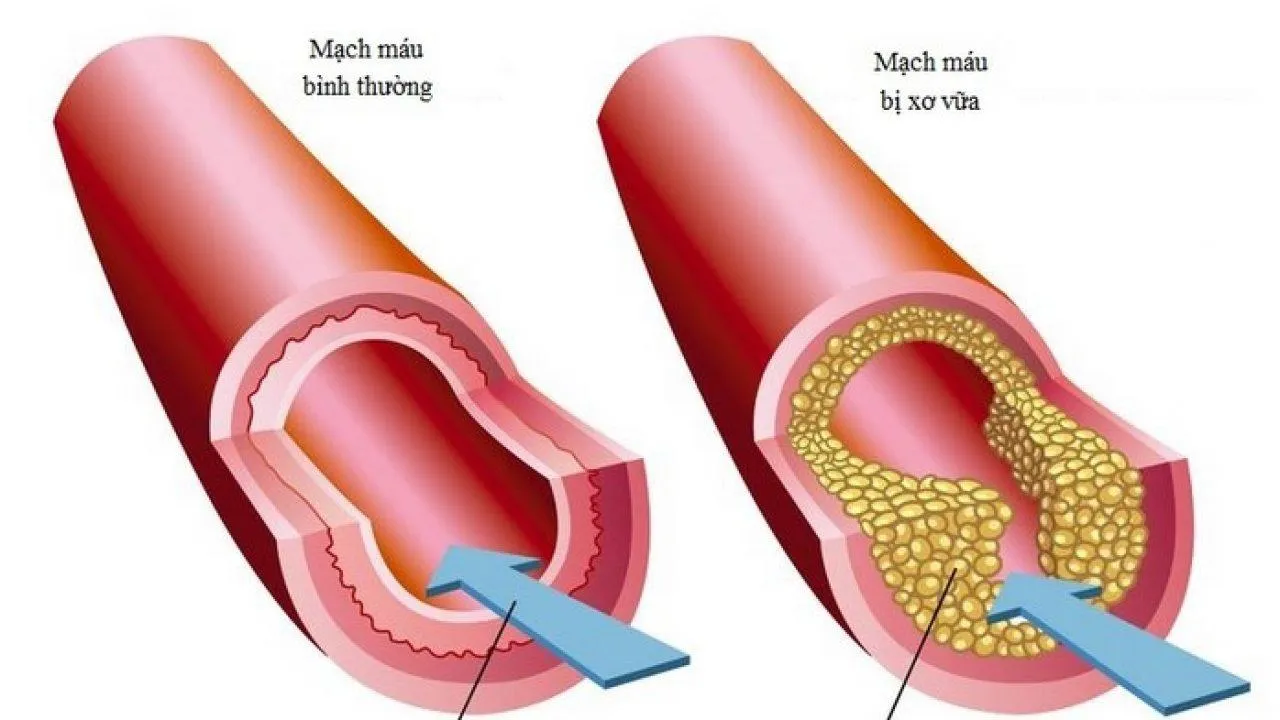 Góc giải đáp: Tại sao việc tầm soát xơ vữa mạch máu rất quan trọng?