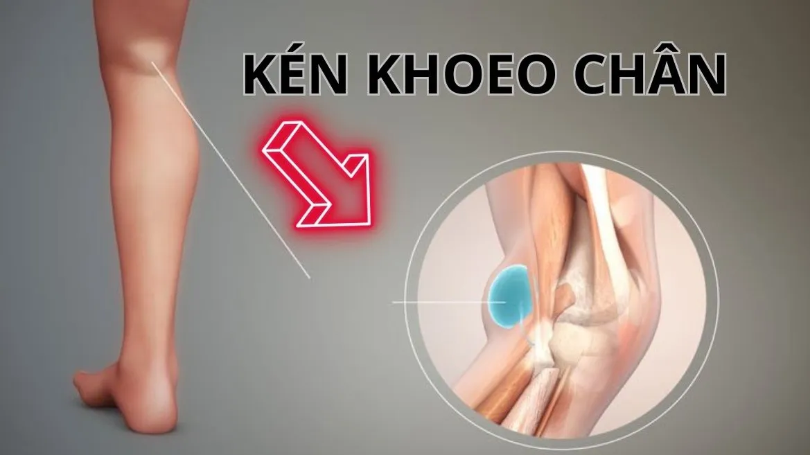 Kén khoeo chân: Nguyên nhân, triệu chứng và cách điều trị