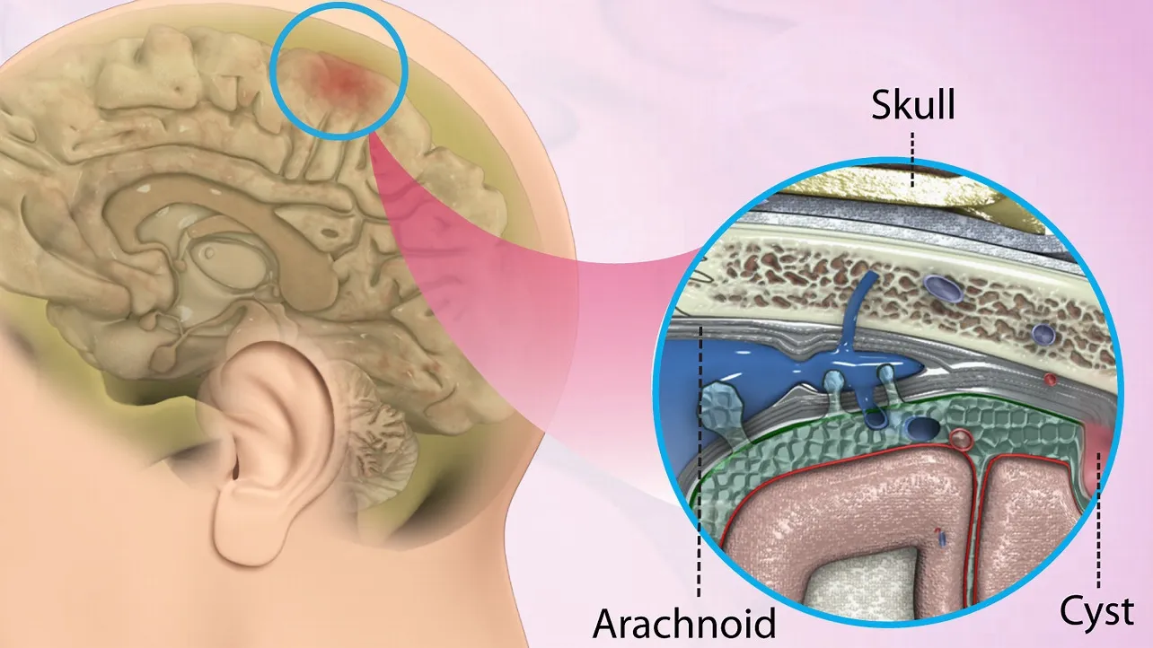 Mối liên quan giữa kích thước nang màng nhện và mức độ nguy hiểm