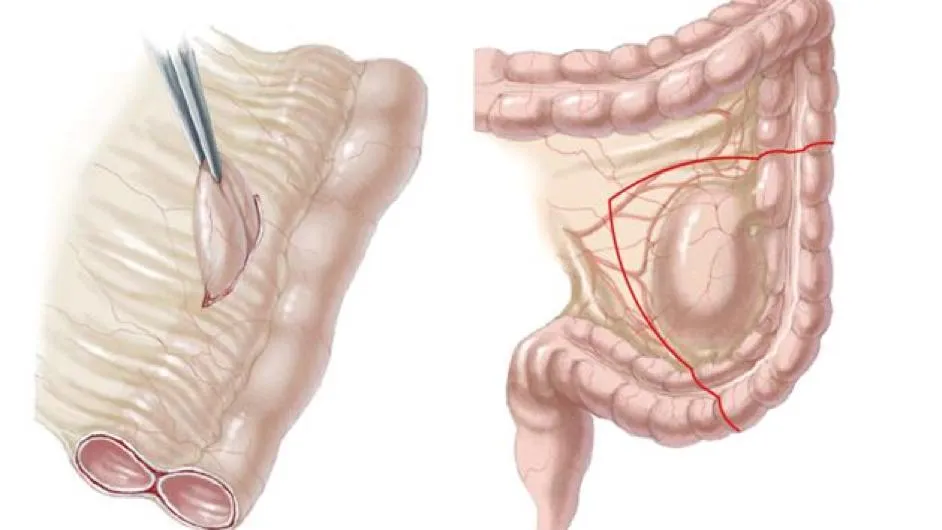 Nang ruột đôi là bệnh gì? Có gây nguy hiểm hay không?