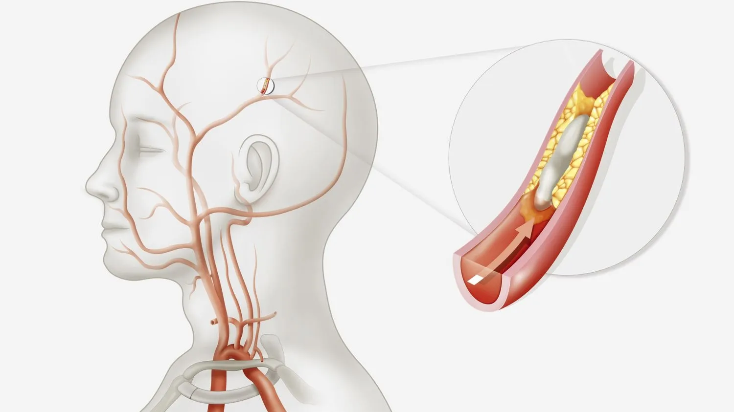 Nguyên nhân tắc mạch máu não và những biện pháp phòng ngừa bệnh