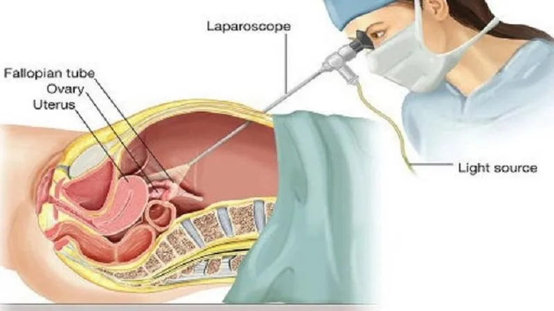 Như thế nào là dẫn lưu bàng quang trên xương mu?