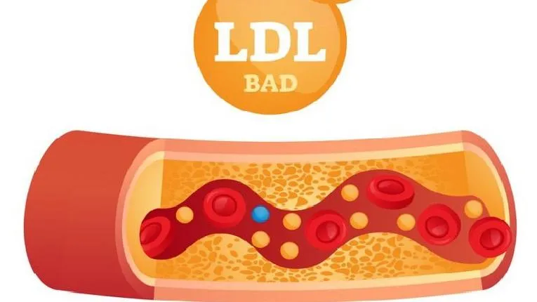 Những điều cần biết về chỉ số LDL cholesterol trong máu