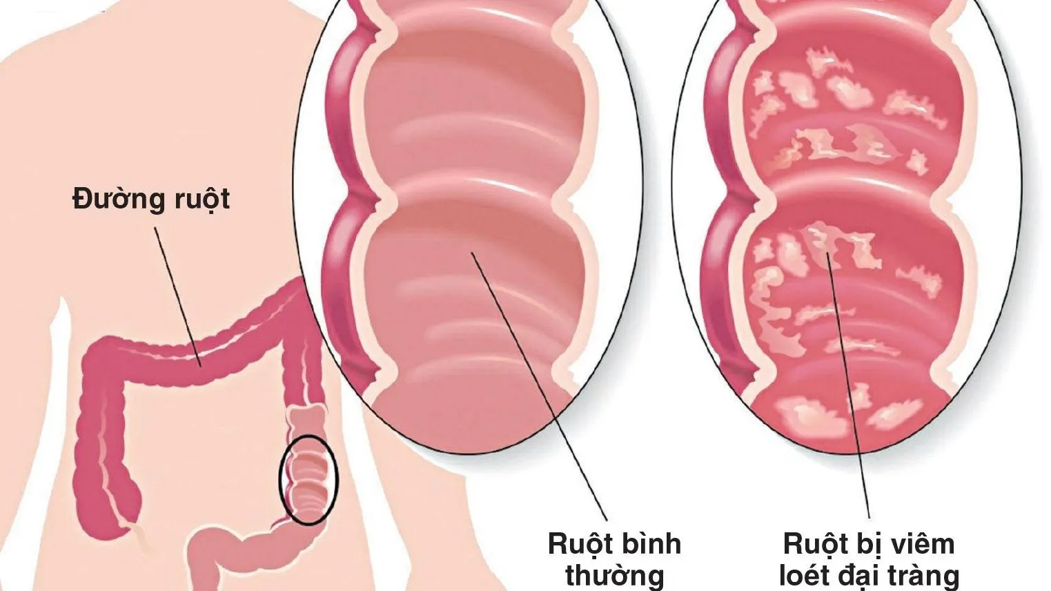 Nội soi đại tràng ống mềm không sinh thiết và những điều cần biết