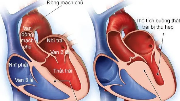 Phì đại tâm thất ở tim là gì? Nguyên nhân và dấu hiệu nhận biết bệnh thế nào?