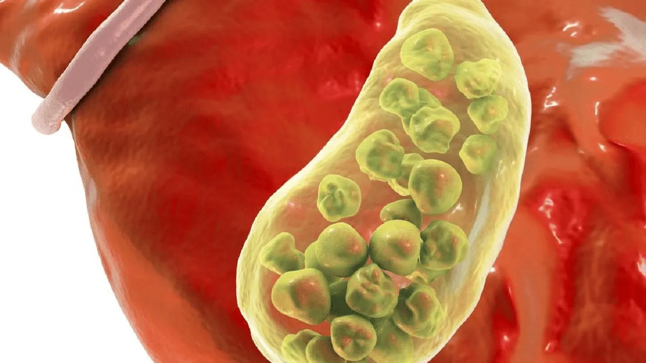 Sỏi cholesterol trong túi mật là gì? Phương pháp điều trị và phòng ngừa hiệu quả