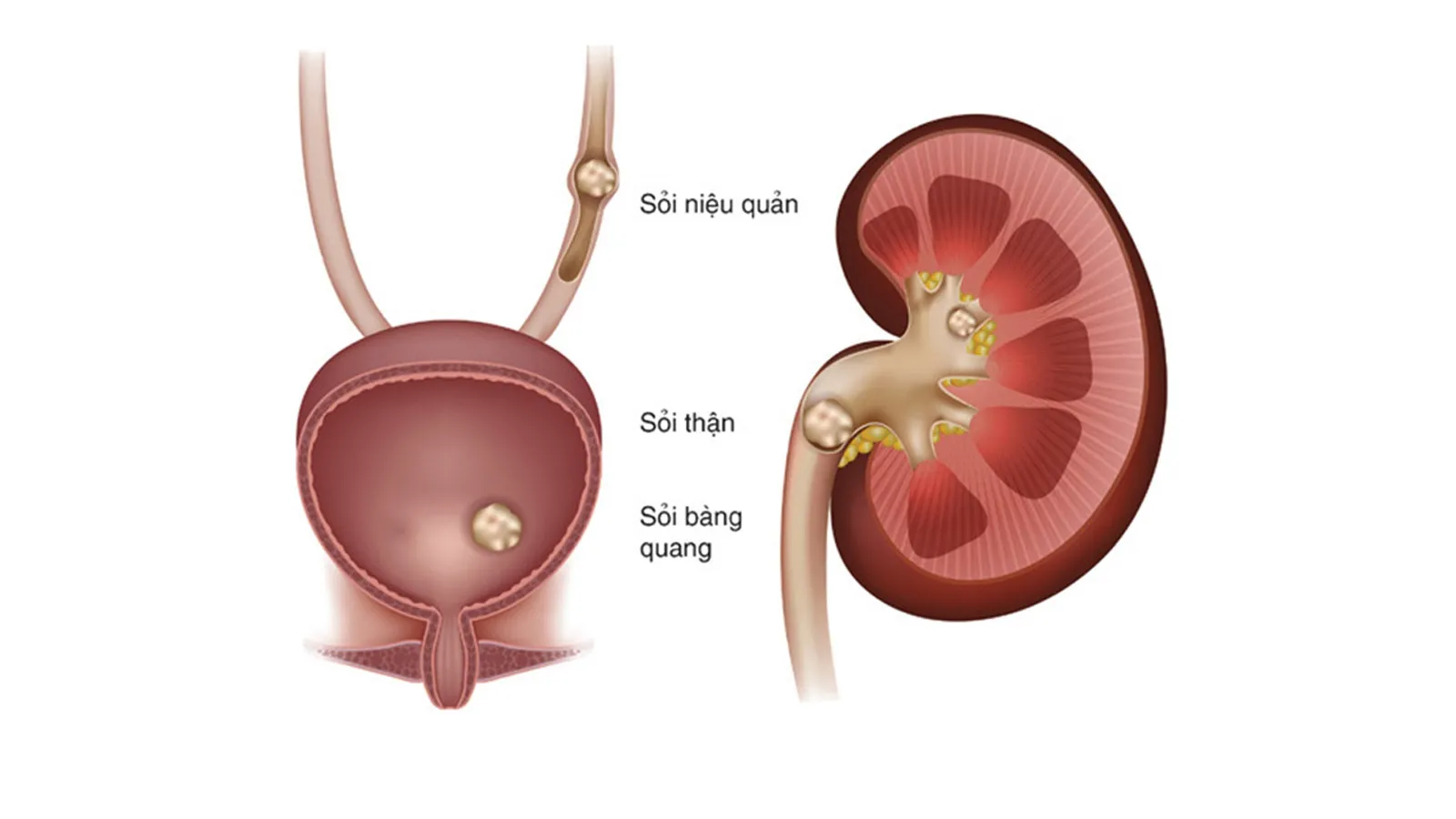 Sỏi niệu quản đoạn sát thành bàng quang điều trị như thế nào?