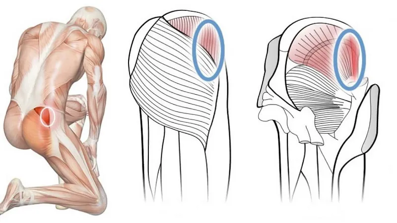 Teo cơ mông và những điều bạn nhất định phải biết