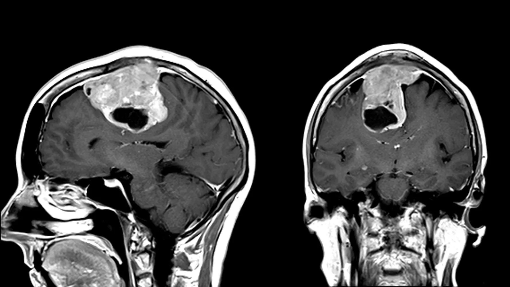 Tìm hiểu về vai trò của chụp MRI u màng não trong chẩn đoán bệnh