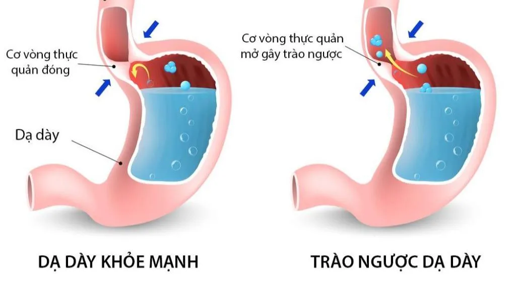 Trào ngược dạ dày độ B: Triệu chứng, nguyên nhân và cách điều trị