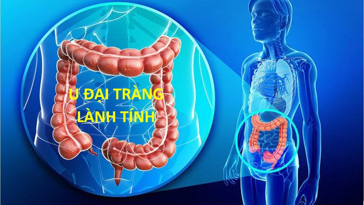 U đại tràng lành tính: Phân loại, chẩn đoán và điều trị