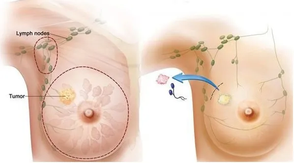 Ung thư vú có nên mổ không? Phương pháp điều trị ung thư vú như thế nào?