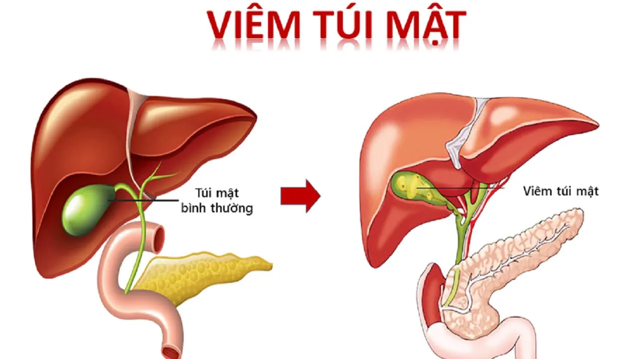 Viêm túi mật hoại tử và những điều cần biết