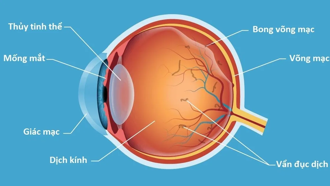 Bệnh võng mạc: Nguyên nhân, triệu chứng và cách điều trị bệnh võng mạc