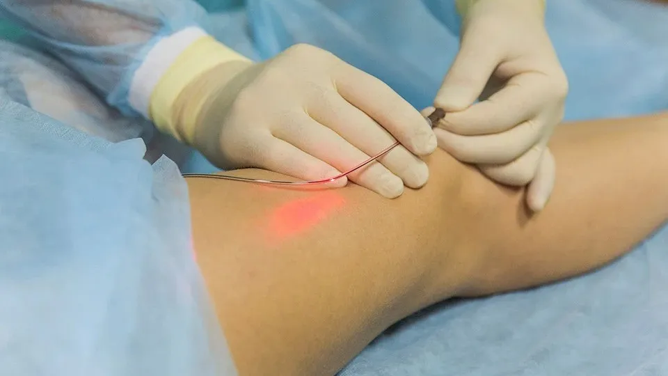 Chi phí điều trị giãn tĩnh mạch bằng laser là bao nhiêu? Quy trình thực hiện như thế nào?