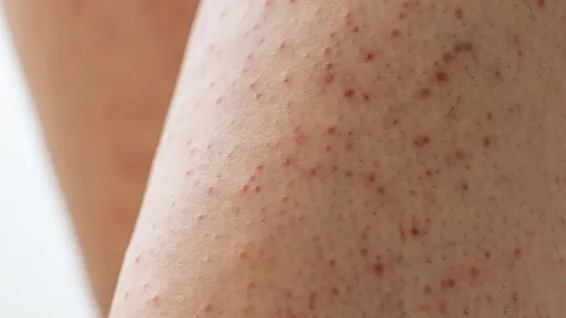 Da bị nổi sần như da gà và ngứa: Dấu hiệu cảnh báo căn bệnh Keratosis Pilaris