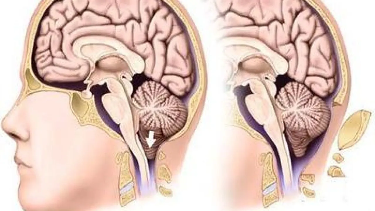 Dị dạng Chiari có mấy loại và có triệu chứng như thế nào?