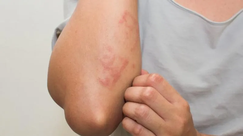 Hội chứng hồng ban nút (erythema nodosum)